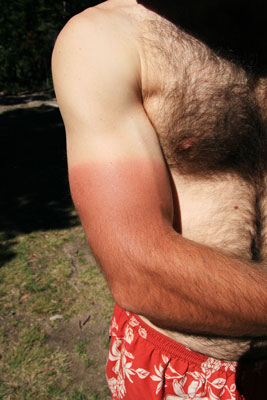 picture of farmer burn