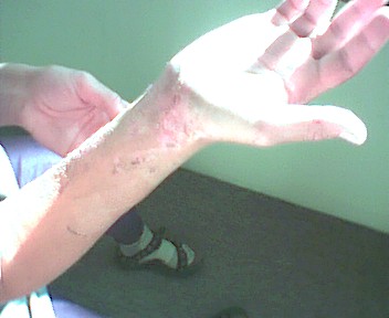 Picture of the arm